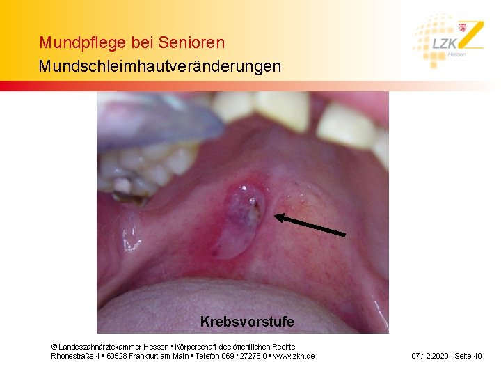 Mundpflege bei Senioren Mundschleimhautveränderungen Krebsvorstufe © Landeszahnärztekammer Hessen • Körperschaft des öffentlichen Rechts Rhonestraße