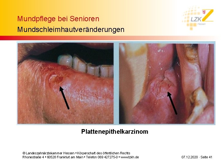 Mundpflege bei Senioren Mundschleimhautveränderungen Plattenepithelkarzinom © Landeszahnärztekammer Hessen • Körperschaft des öffentlichen Rechts Rhonestraße