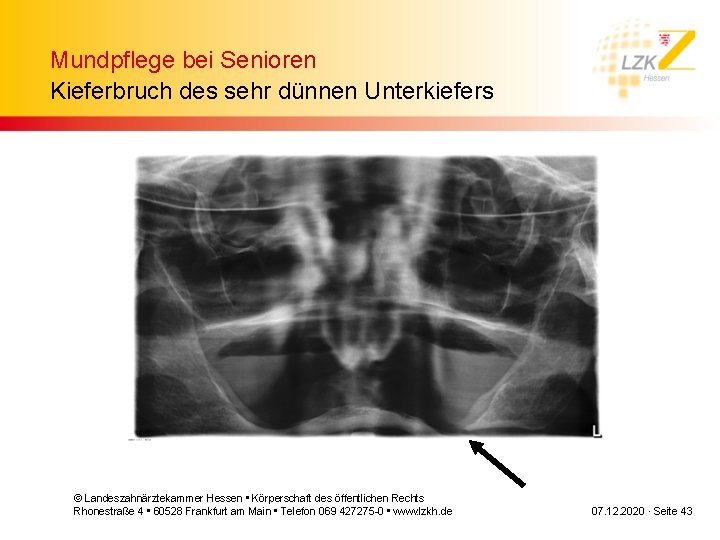 Mundpflege bei Senioren Kieferbruch des sehr dünnen Unterkiefers © Landeszahnärztekammer Hessen • Körperschaft des