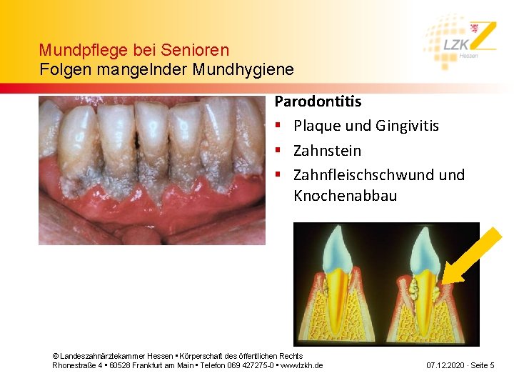 Mundpflege bei Senioren Folgen mangelnder Mundhygiene Parodontitis § Plaque und Gingivitis § Zahnstein §