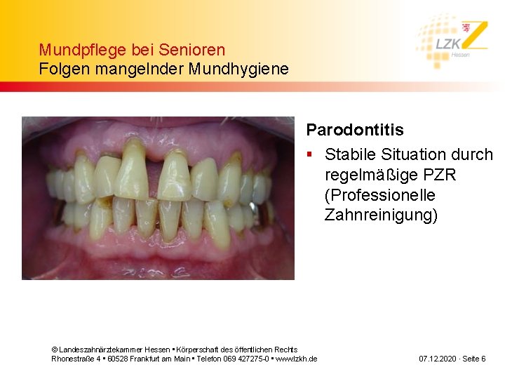 Mundpflege bei Senioren Folgen mangelnder Mundhygiene Parodontitis § Stabile Situation durch regelmäßige PZR (Professionelle