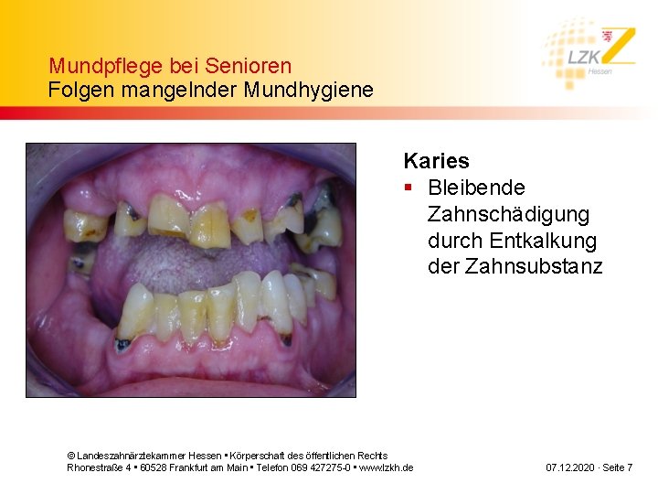 Mundpflege bei Senioren Folgen mangelnder Mundhygiene Karies § Bleibende Zahnschädigung durch Entkalkung der Zahnsubstanz