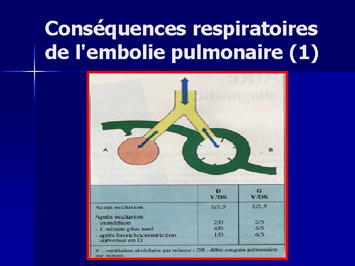 Conséquences respiratoires de l'embolie pulmonaire (1) 