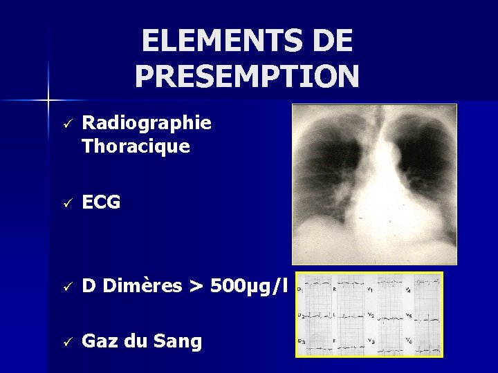 ELEMENTS DE PRESEMPTION ü Radiographie Thoracique ü ECG ü D Dimères > 500µg/l ü