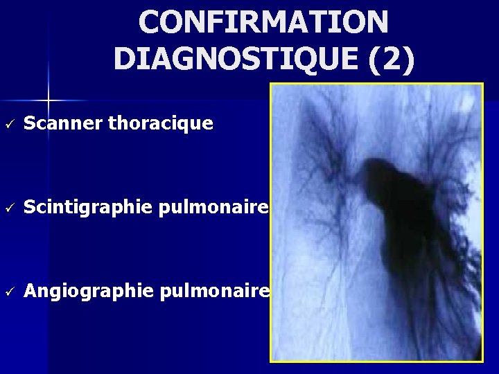 CONFIRMATION DIAGNOSTIQUE (2) ü Scanner thoracique ü Scintigraphie pulmonaire ü Angiographie pulmonaire 