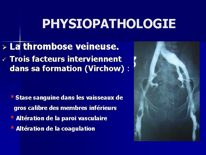 PHYSIOPATHOLOGIE Ø ü La thrombose veineuse. Trois facteurs interviennent dans sa formation (Virchow) :
