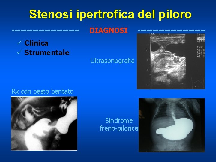 Stenosi ipertrofica del piloro DIAGNOSI ü Clinica ü Strumentale Ultrasonografia Rx con pasto baritato