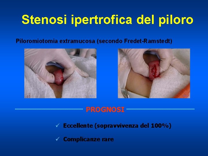 Stenosi ipertrofica del piloro Piloromiotomia extramucosa (secondo Fredet-Ramstedt) PROGNOSI ü Eccellente (sopravvivenza del 100%)
