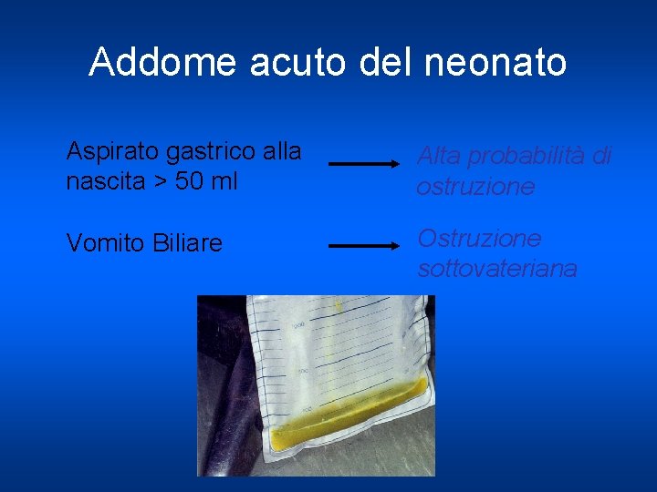 Addome acuto del neonato Aspirato gastrico alla nascita > 50 ml Alta probabilità di