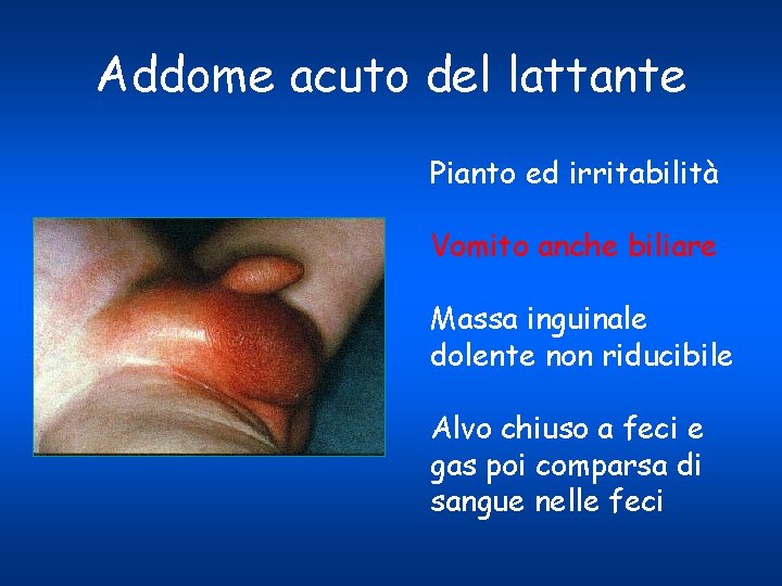 Addome acuto del lattante Pianto ed irritabilità Vomito anche biliare Massa inguinale dolente non