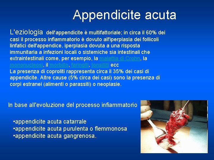 Appendicite acuta L'eziologia dell'appendicite è multifattoriale; in circa il 60% dei casi il processo