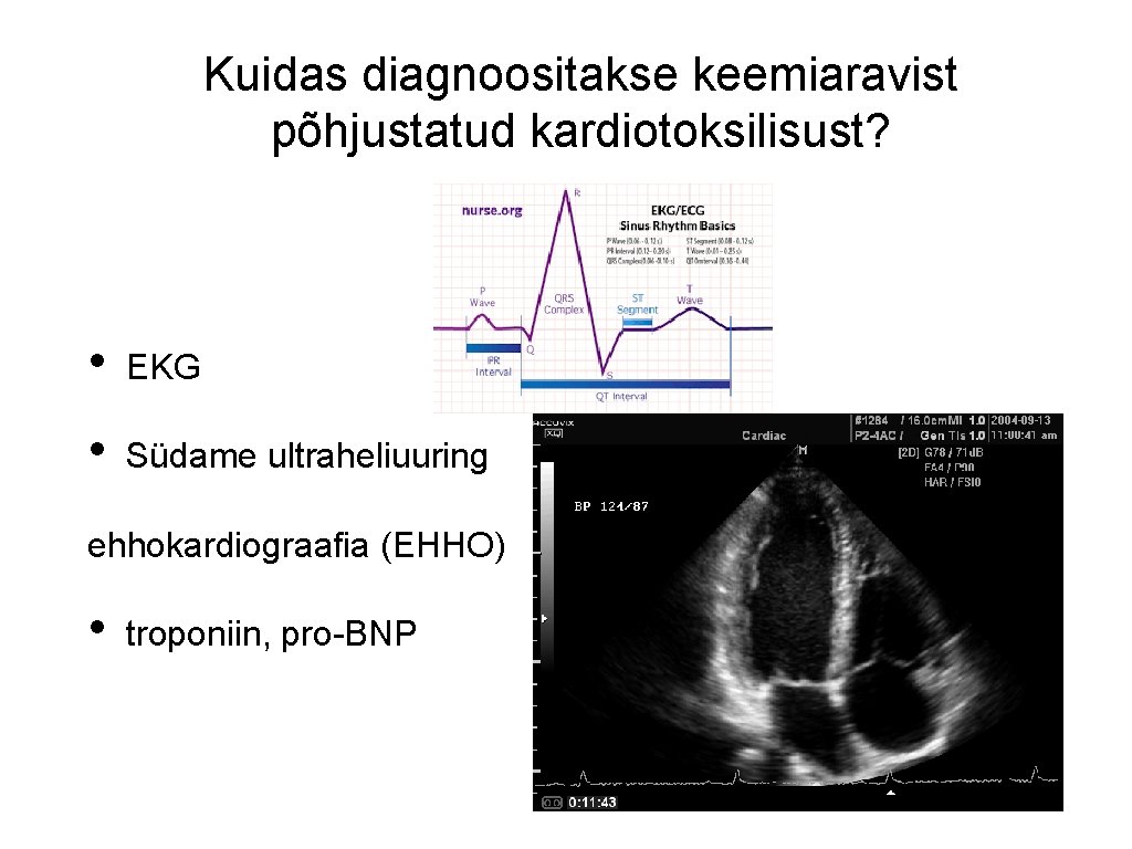 Kuidas diagnoositakse keemiaravist põhjustatud kardiotoksilisust? • EKG • Südame ultraheliuuring ehhokardiograafia (EHHO) • troponiin,