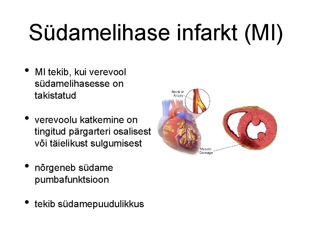 Südamelihase infarkt (MI) • MI tekib, kui verevool südamelihasesse on takistatud • verevoolu katkemine
