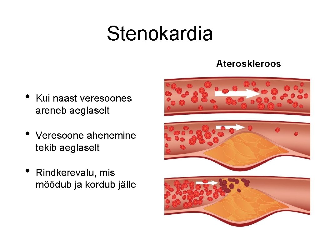 Stenokardia Ateroskleroos • Kui naast veresoones areneb aeglaselt • Veresoone ahenemine tekib aeglaselt •
