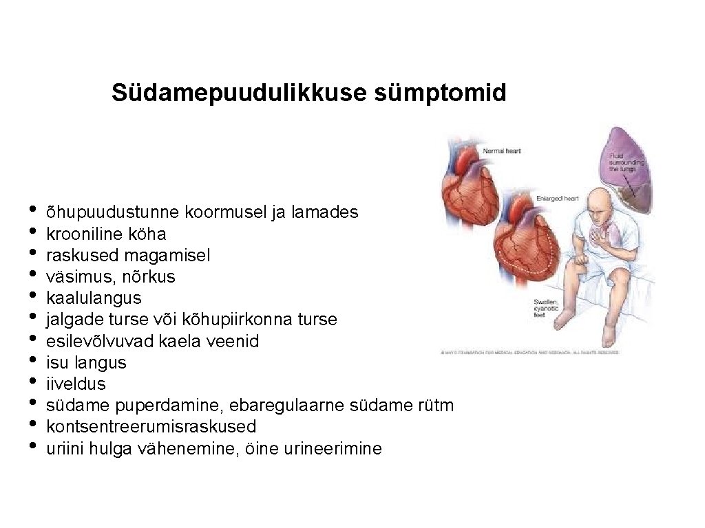 Südamepuudulikkuse sümptomid • • • õhupuudustunne koormusel ja lamades krooniline köha raskused magamisel väsimus,