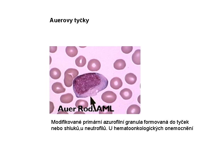 Auerovy tyčky Modifikované primární azurofilní granula formovaná do tyček nebo shluků, u neutrofilů. U