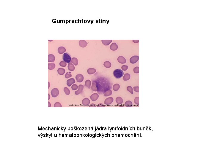 Gumprechtovy stíny Mechanicky poškozená jádra lymfoidních buněk, výskyt u hematoonkologických onemocnění. 