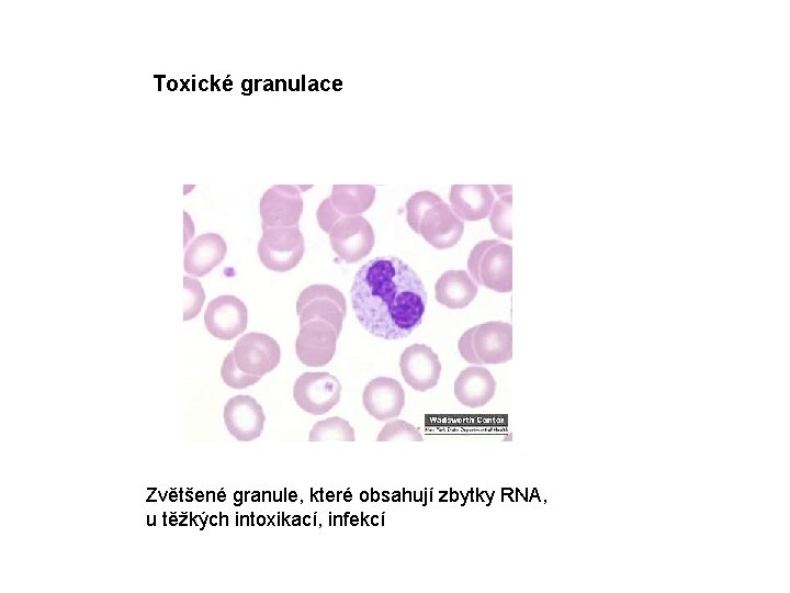 Toxické granulace Zvětšené granule, které obsahují zbytky RNA, u těžkých intoxikací, infekcí 