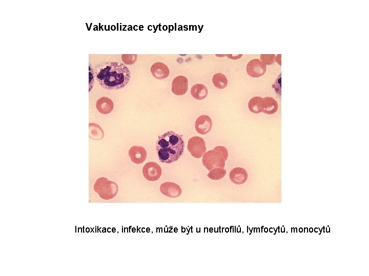 Vakuolizace cytoplasmy Intoxikace, infekce, může být u neutrofilů, lymfocytů, monocytů 