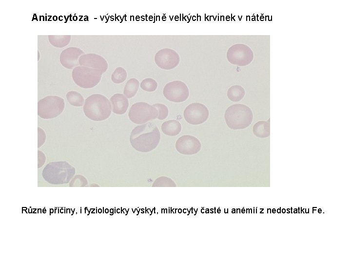 Anizocytóza - výskyt nestejně velkých krvinek v nátěru Různé příčiny, i fyziologicky výskyt, mikrocyty