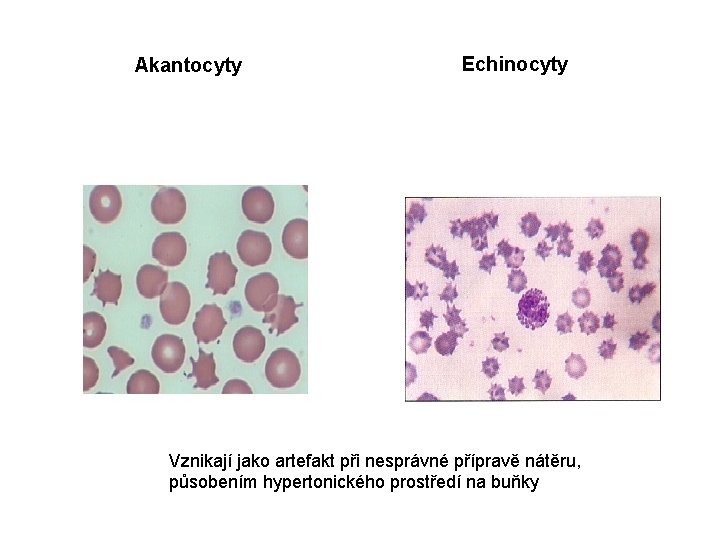 Akantocyty Echinocyty Vznikají jako artefakt při nesprávné přípravě nátěru, působením hypertonického prostředí na buňky