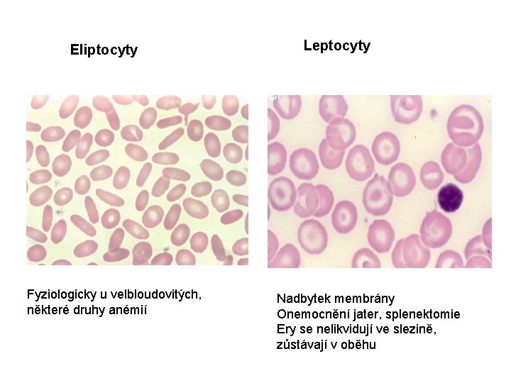 Eliptocyty Fyziologicky u velbloudovitých, některé druhy anémií Leptocyty Nadbytek membrány Onemocnění jater, splenektomie Ery