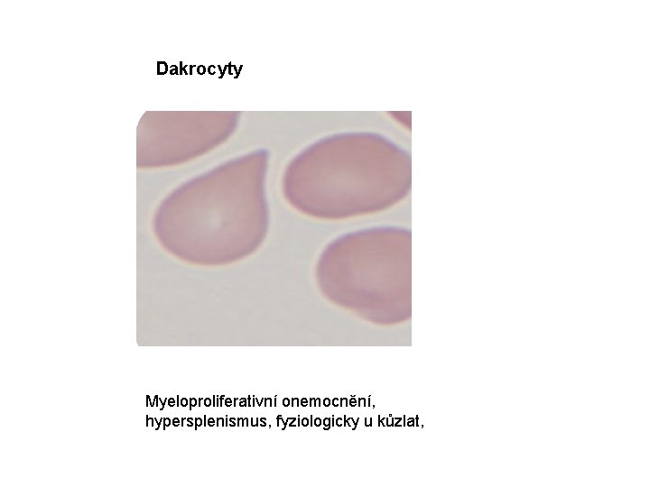Dakrocyty Myeloproliferativní onemocnění, hypersplenismus, fyziologicky u kůzlat, 