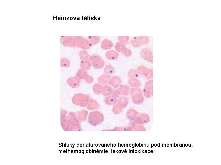 Heinzova tělíska Shluky denaturovaného hemoglobinu pod membránou, methemoglobinémie, lékové intoxikace 