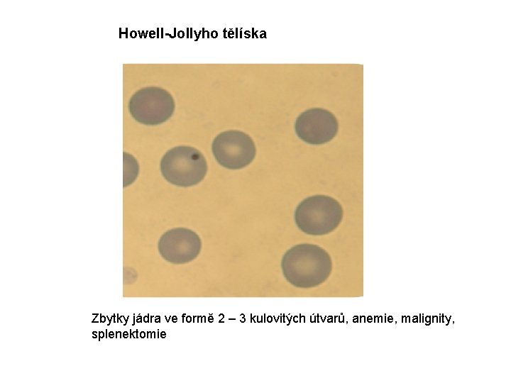 Howell-Jollyho tělíska Zbytky jádra ve formě 2 – 3 kulovitých útvarů, anemie, malignity, splenektomie