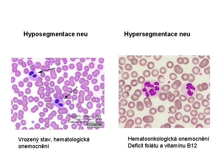 Hyposegmentace neu Vrozený stav, hematologická onemocnění Hypersegmentace neu Hematoonkologická onemocnění Deficit folátu a vitamínu