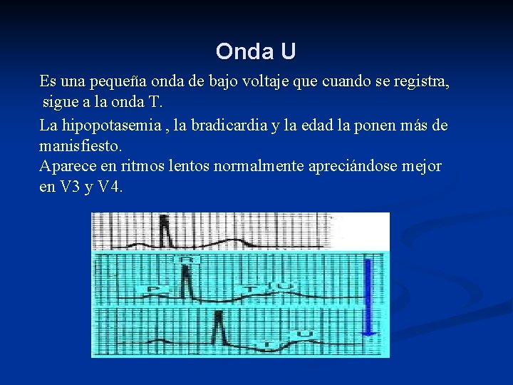 Onda U Es una pequeña onda de bajo voltaje que cuando se registra, sigue