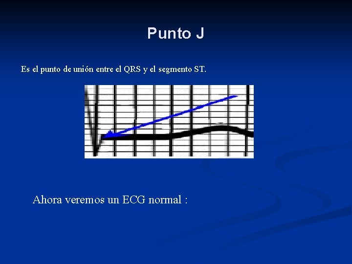 Punto J Es el punto de unión entre el QRS y el segmento ST.
