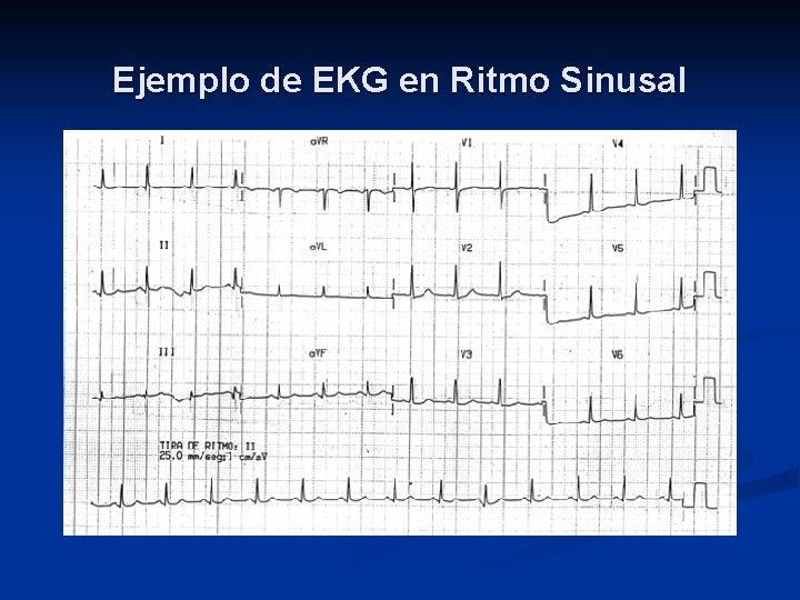 Ejemplo de EKG en Ritmo Sinusal 