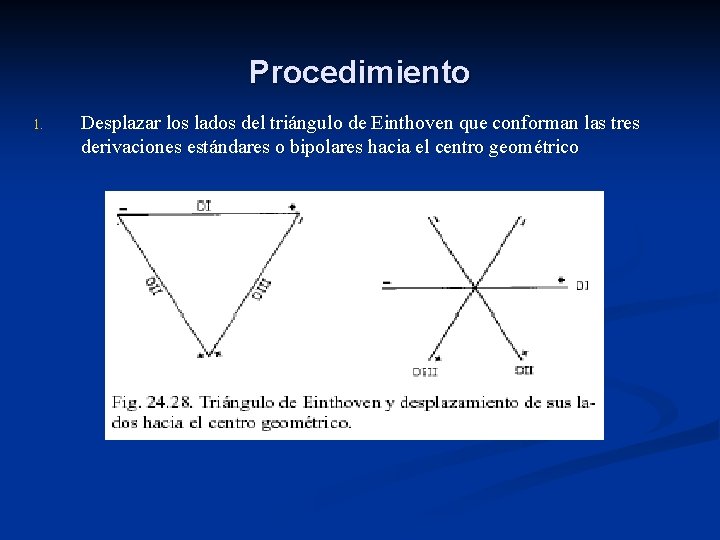 Procedimiento 1. Desplazar los lados del triángulo de Einthoven que conforman las tres derivaciones
