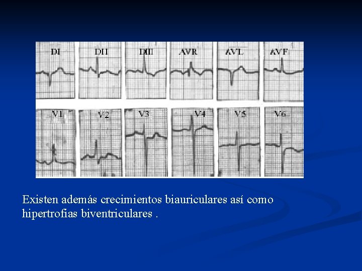 Existen además crecimientos biauriculares así como hipertrofias biventriculares. 