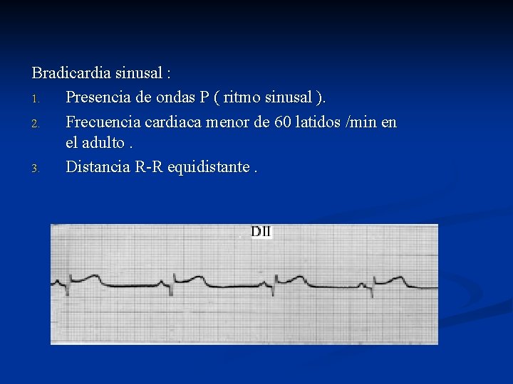 Bradicardia sinusal : 1. Presencia de ondas P ( ritmo sinusal ). 2. Frecuencia