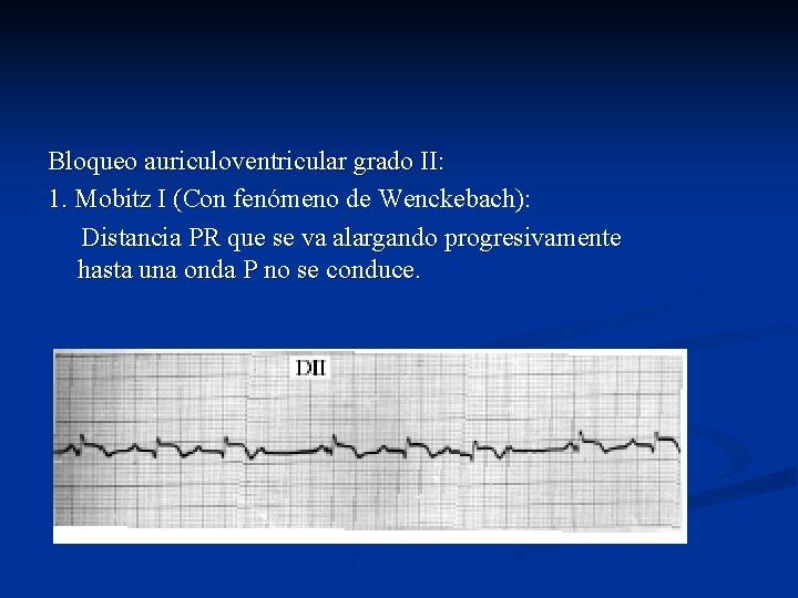 Bloqueo auriculoventricular grado II: 1. Mobitz I (Con fenómeno de Wenckebach): 1. Mobitz I