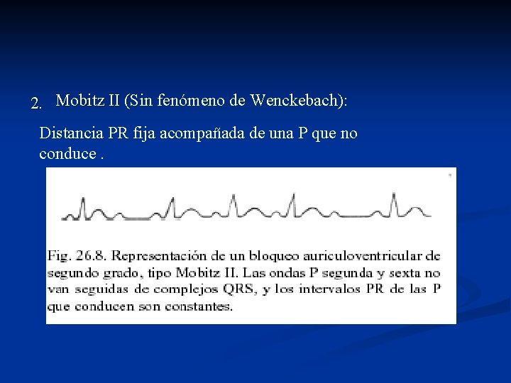 Mobitz II ( 2. Mobitz II (Sin fenómeno de Wenckebach): Distancia PR fija acompañada