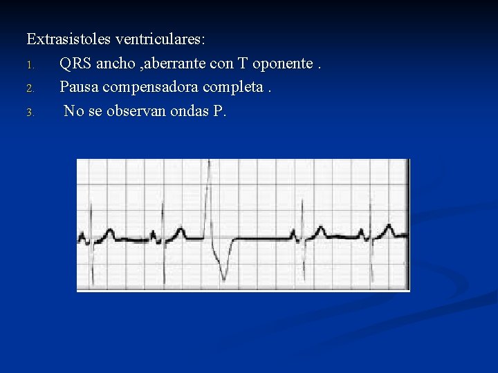 Extrasistoles ventriculares: 1. QRS ancho , aberrante con T oponente. 2. Pausa compensadora completa.
