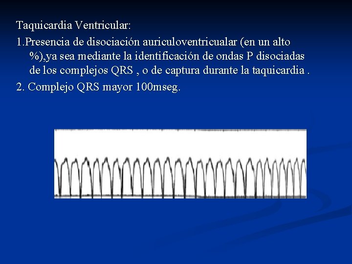 Taquicardia Ventricular: 1. Presencia de disociación auriculoventricualar (en un alto %), ya sea mediante
