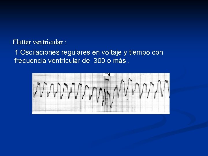 Flutter ventricular : 1. Oscilaciones regulares en voltaje y tiempo con frecuencia ventricular de