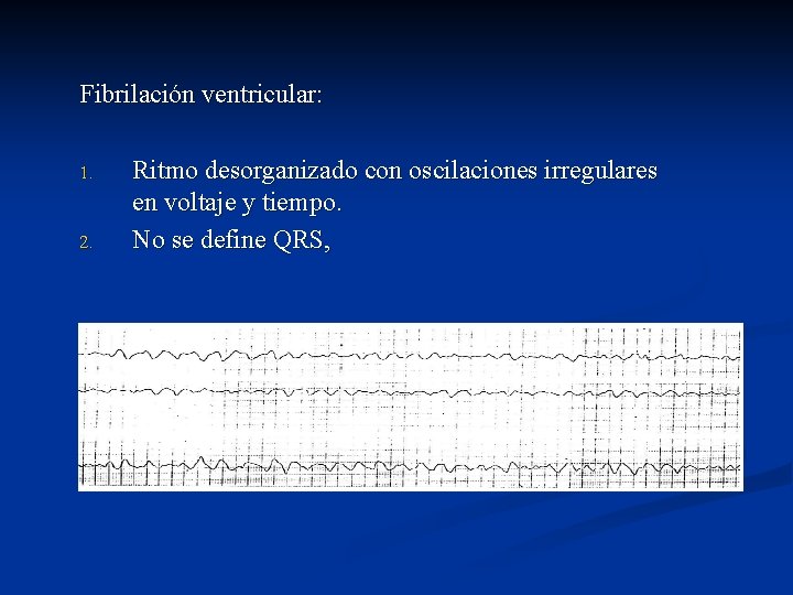 Fibrilación ventricular: 1. 2. Ritmo desorganizado con oscilaciones irregulares en voltaje y tiempo. No