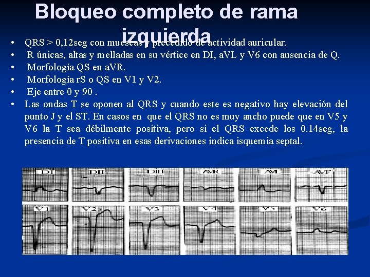  • • • Bloqueo completo de rama izquierda QRS > 0, 12 seg