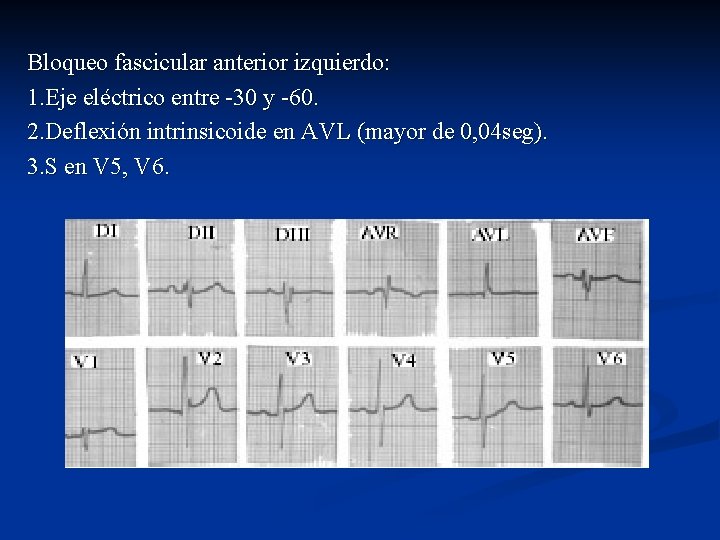 Bloqueo fascicular anterior izquierdo: 1. Eje eléctrico entre -30 y -60. 2. Deflexión intrinsicoide