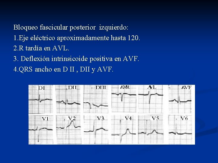 Bloqueo fascicular posterior izquierdo: 1. Eje eléctrico aproximadamente hasta 120. 2. R tardía en