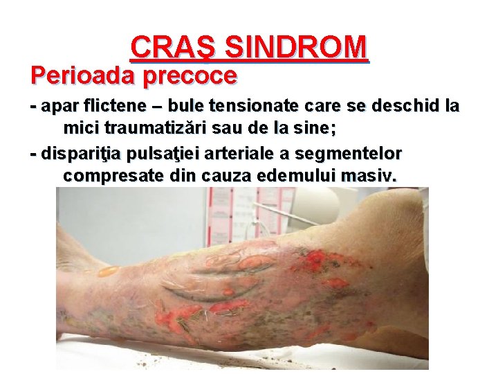 CRAŞ SINDROM Perioada precoce - apar flictene – bule tensionate care se deschid la