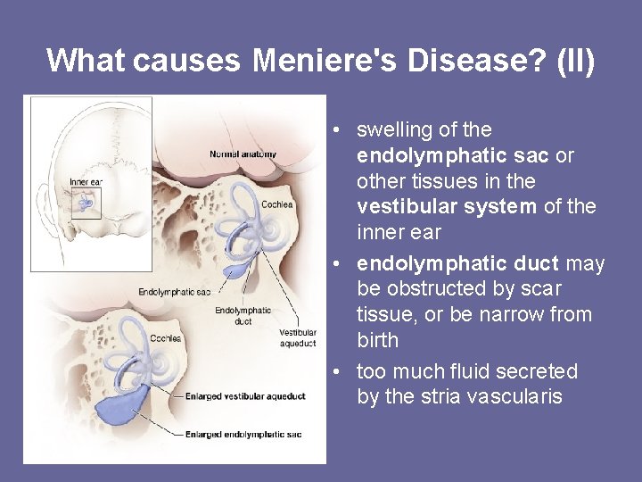 What causes Meniere's Disease? (II) • swelling of the endolymphatic sac or other tissues