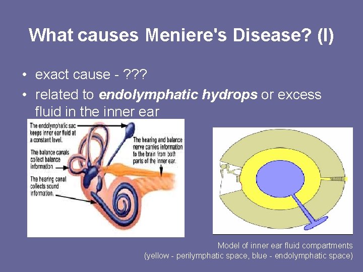 What causes Meniere's Disease? (I) • exact cause - ? ? ? • related