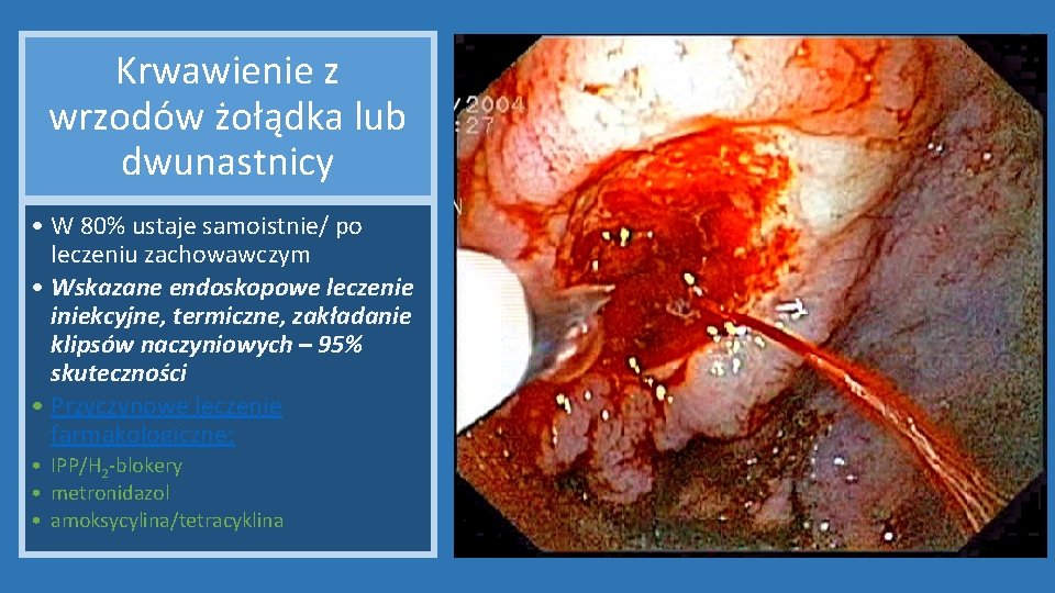 Krwawienie z wrzodów żołądka lub dwunastnicy • W 80% ustaje samoistnie/ po leczeniu zachowawczym