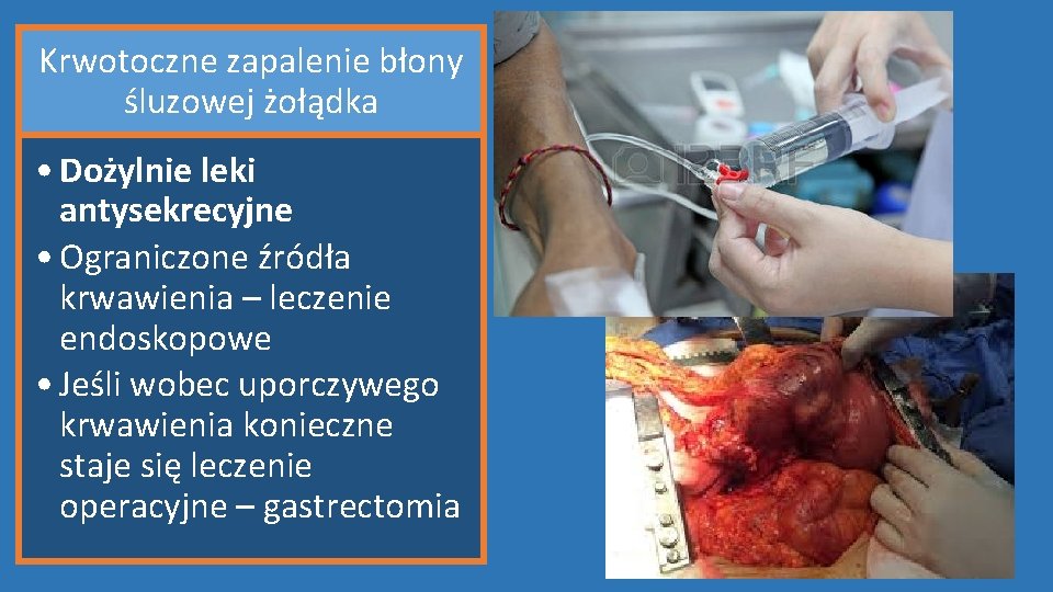 Krwotoczne zapalenie błony śluzowej żołądka • Dożylnie leki antysekrecyjne • Ograniczone źródła krwawienia –